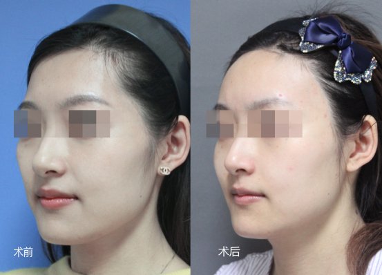 脸部填充脂肪的副作用