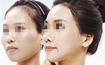 面部填脂肪要多久恢复