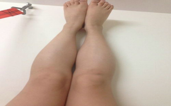 自体脂肪填充小腿?