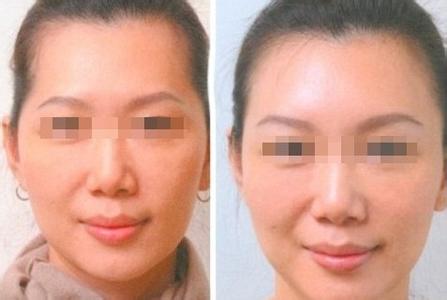 自体脂肪填充鼻梁好吗