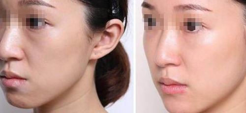 自体脂肪填充鼻唇沟多少钱