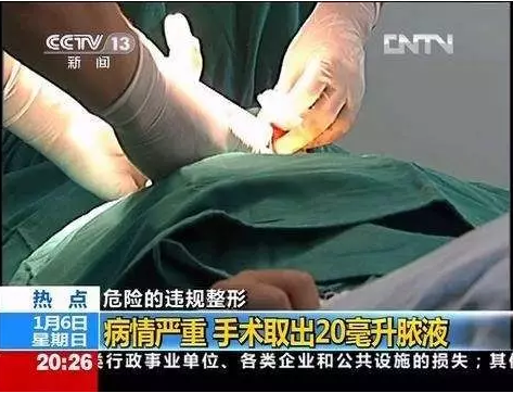 自体脂肪填充面部手术副作用