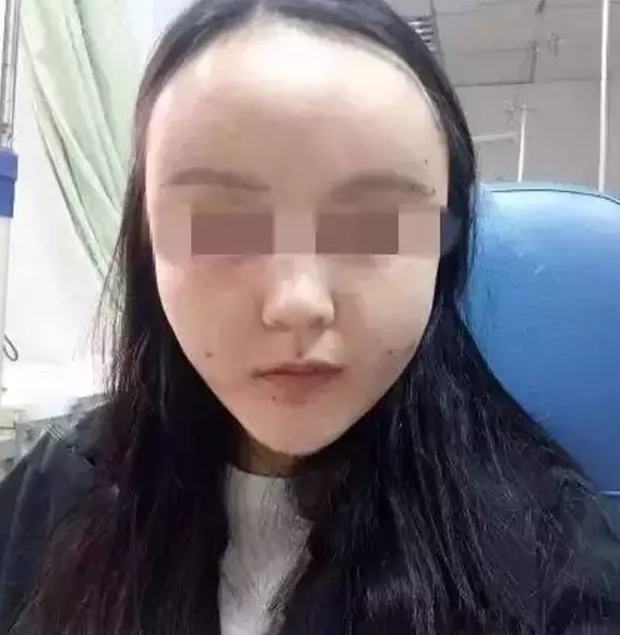 面部整体脂肪移植副作用