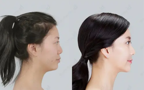 长沙哪家医院颌骨整形手术做得好?