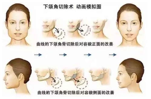 北京下颌角截骨哪家医院口碑比较好？