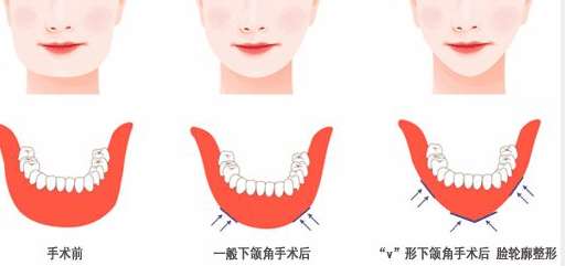 下颌角手术完全恢复要多久