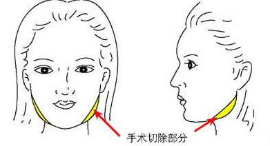 下颌骨宽怎么办