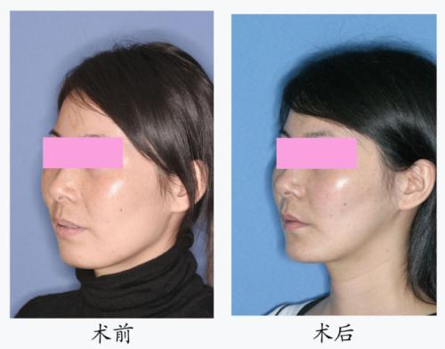 正颌手术后脸型改变大吗	
