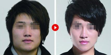 男生下颚骨整形后遗症?