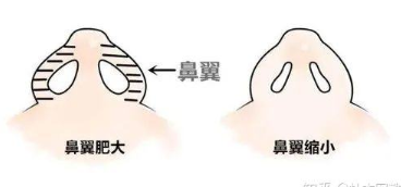做鼻翼缩小大概多少钱