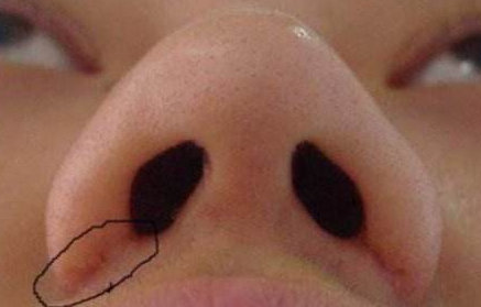 鼻翼缩小术后增生图片