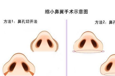 鼻翼鼻头缩小过程图