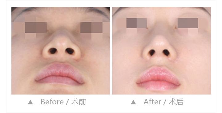 蒜头鼻矫正的术后护理?