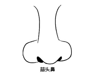 怎么才能改善蒜头鼻？