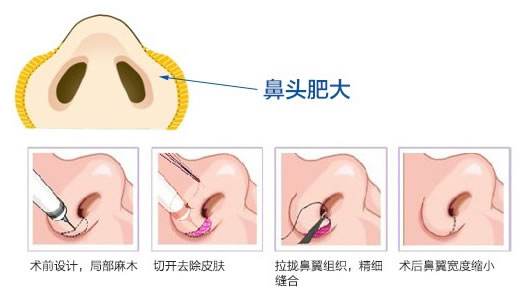 蒜头鼻矫正手术怎么做？