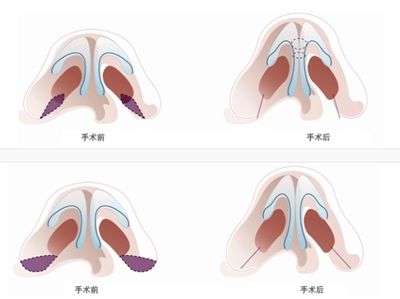 改善蒜头鼻的方法是什么？