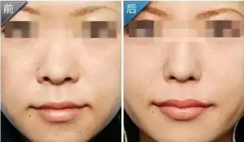 如何拯救蒜头鼻？