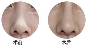 什么是蒜头鼻？蒜头鼻图片