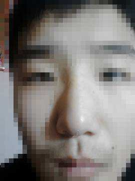蒜头鼻不手术怎么改善