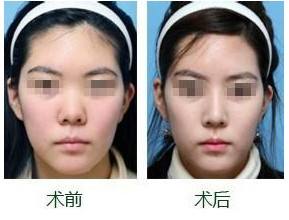 蒜头鼻矫正手术的注意事项