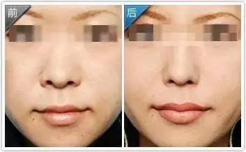 蒜头鼻不整容能改善吗