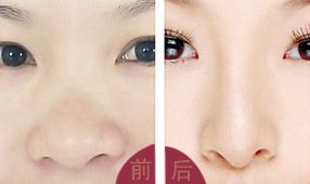 不同原因蒜头鼻的整形方式