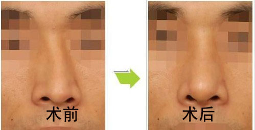 歪鼻矫正术后护理