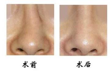 歪鼻矫正手术的具体方法