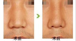 歪鼻矫正手术的适应和禁忌症