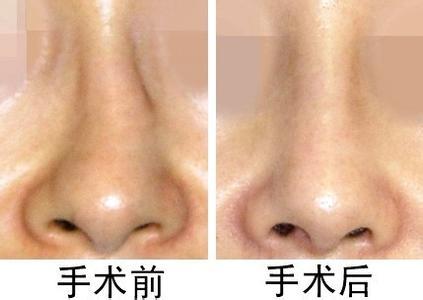 鼻梁歪能矫正吗