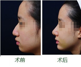 鼻梁骨歪矫正多少钱