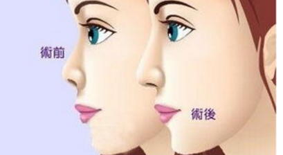 歪鼻矫正前后对比