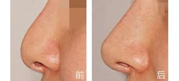鼻翼缩小术真的是永久的吗