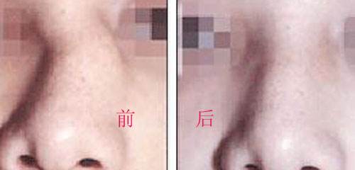 歪鼻鼻型矫正不适合哪些人群