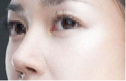 宁波做歪鼻矫正好不好