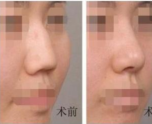 驼峰鼻矫正前后对比照