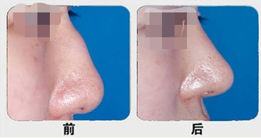 驼峰鼻矫正前后对比图