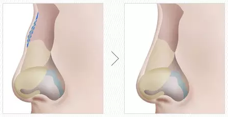 驼峰鼻矫正前后对比照片