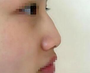 驼峰鼻矫正护理方法