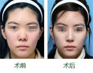 隆鼻后假体下滑怎么修复