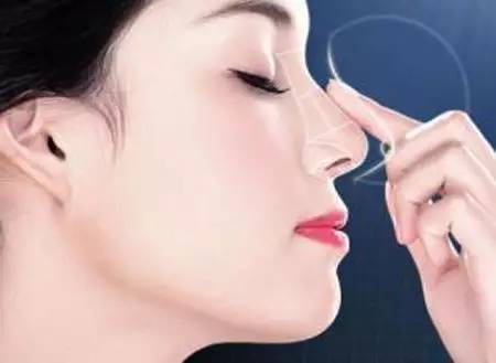 软骨垫鼻子价格
