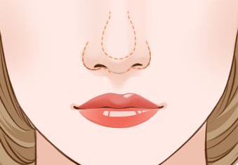 鼻头肥大怎么矫正