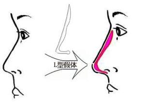 大鼻子怎么整容