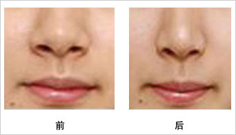 鼻翼缺损简介
