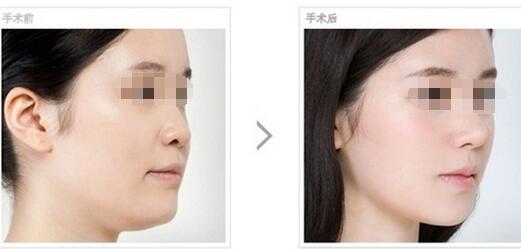 鼻头缩小的价格需要多少