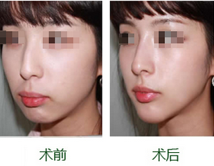 上海鼻头缩小手术费用