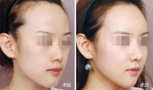 宁波哪里最擅长鼻头缩小手术