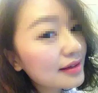 宁波做鼻头缩小的价格是多少