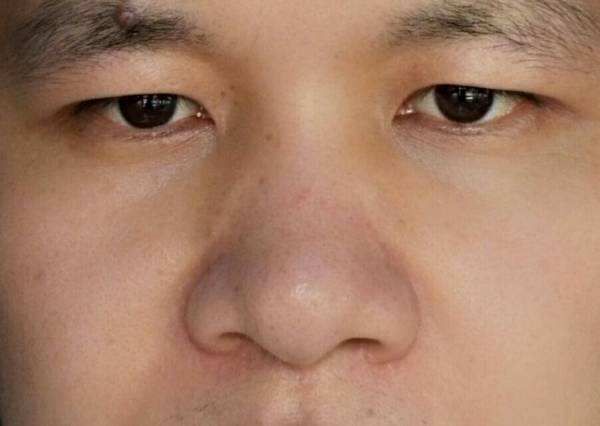 你了解鼻头整形手术吗
