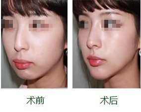 鼻头肥大是啥原因